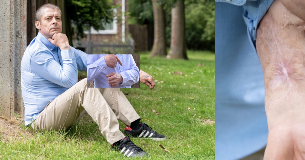 Otec od rodiny přišel kvůli infekci o své mužství. Doktoři mu na ruku přišili náhradní a takto to vypadá Náhledový obrázek