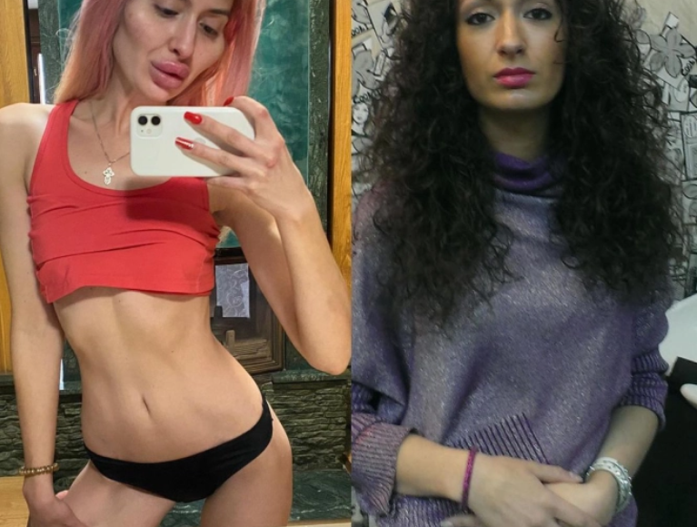 Chtěla mít nejkrásnější tváře na světě, botox z ní však udělal zrůdu: Svého rozhodnutí však nelituje. Co na ní říkáte? Náhledový obrázek