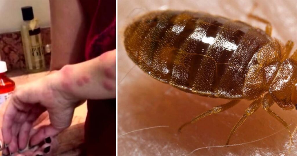 Odborníci toto léto varují před štěnicemi. Zde je návod, jak se můžete chránit Náhledový obrázek