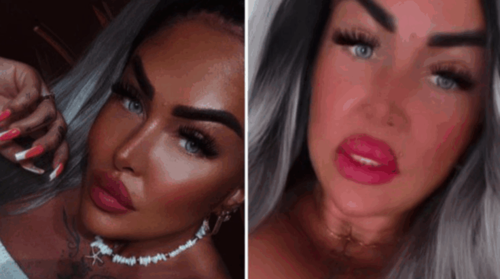 Marie Růžičková šokovala novou procedurou: po náročné operaci čelisti si zvětšila rty Náhledový obrázek